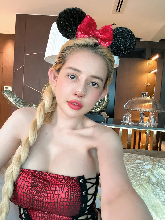 Diện mạo hiện tại của Ngân 98 sau khi phải tháo sụn mũi. (Ảnh: FBNV)