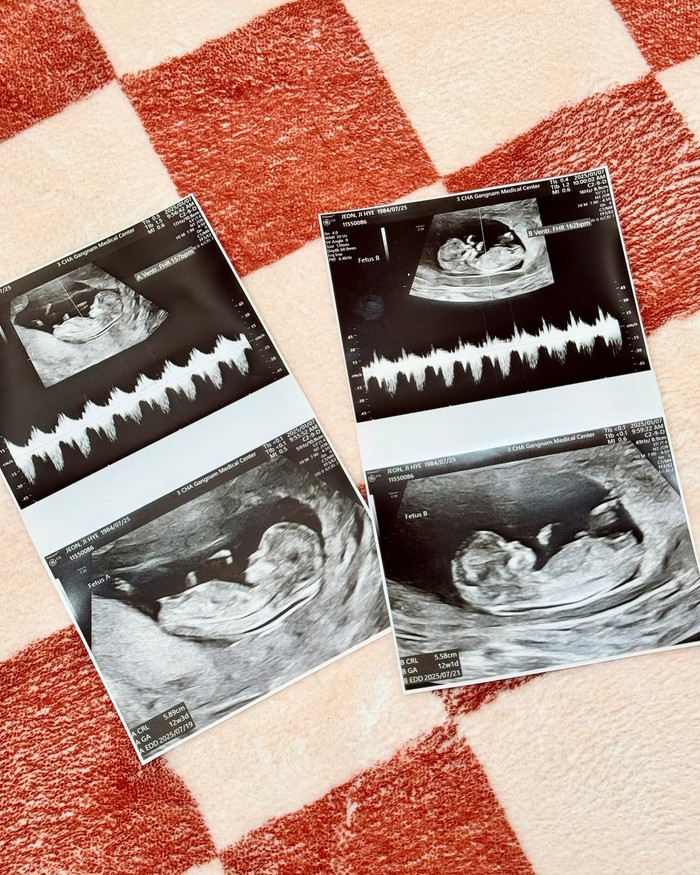 Cặp đôi vui mừng thông báo đã có song thai nhờ thụ tinh nhân tạo.