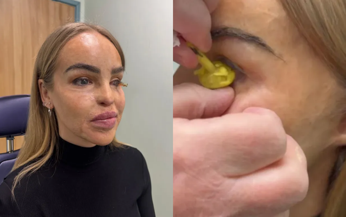 Nữ người mẫu đã hoàn thành xong quá trình phẫu thuật gắn mắt giả.