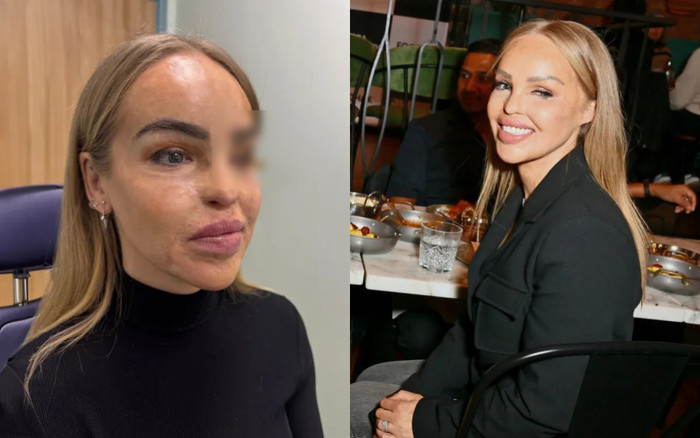 Bị bạn trai cũ tấn công, nữ người mẫu phải gắn mắt giả và phẫu thuật hơn 400 lần Ảnh 2