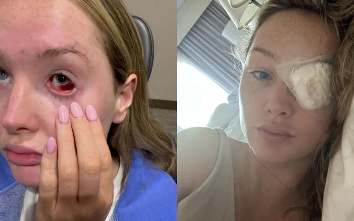 Nữ người mẫu mù một bên mắt vì bị bạn thân 'tác động' bằng túi Dior Ảnh 2