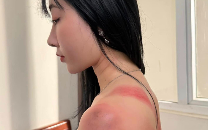 Nữ diễn viên Việt gây bất ngờ khi đăng ảnh bầm tím khắp người Ảnh 2