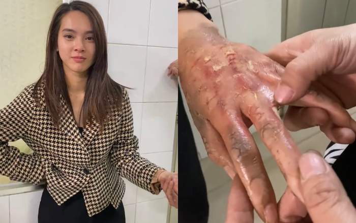 Nữ diễn viên Quỳnh Lương với bàn tay biến dạng vì bỏng. (Ảnh: TikTok Myy Đà Lạt)
