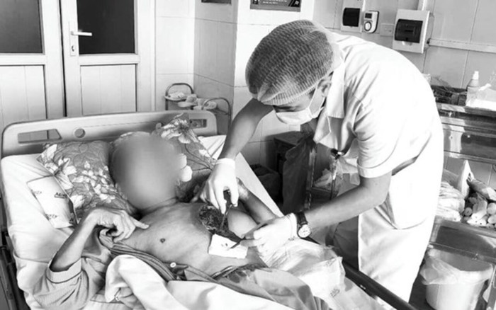 Người đàn ông hoại tử mô cơ ngực trái do nhiễm nấm sau khi dọn nghĩa trang cuối năm Ảnh 2