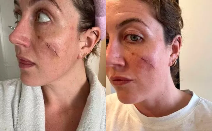 Vết sẹo trên má của Steph Warkotsch là khối u nang tuyến bã nhờn. Cô đã phẫu thuật loại bỏ và được khâu lại khoảng 30 phút. (Ảnh: The Mirror)