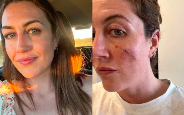 Người phụ nữ bàng hoàng khi nặn vết thâm trên má, phải phẫu thuật và khâu đến 30 mũi Ảnh 2