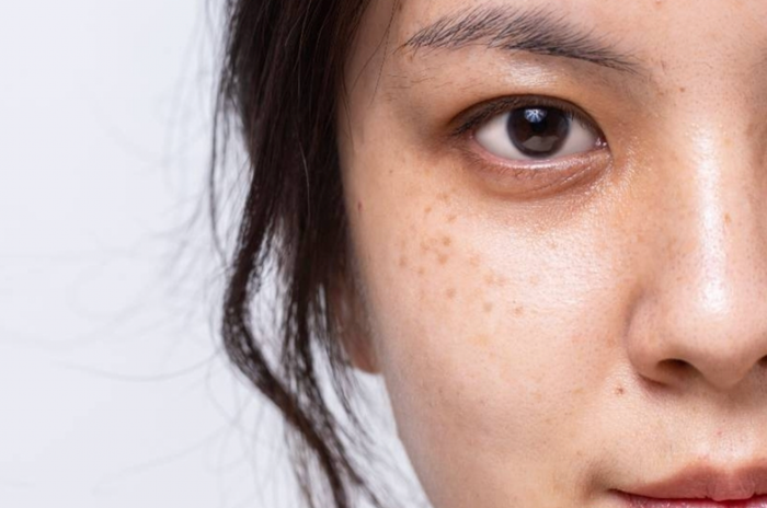 Chị em ở độ tuổi từ 30 cũng khó tránh khỏi tình trạng xuất hiện tàn nhang và đốm nâu trên da. (Ảnh minh họa)