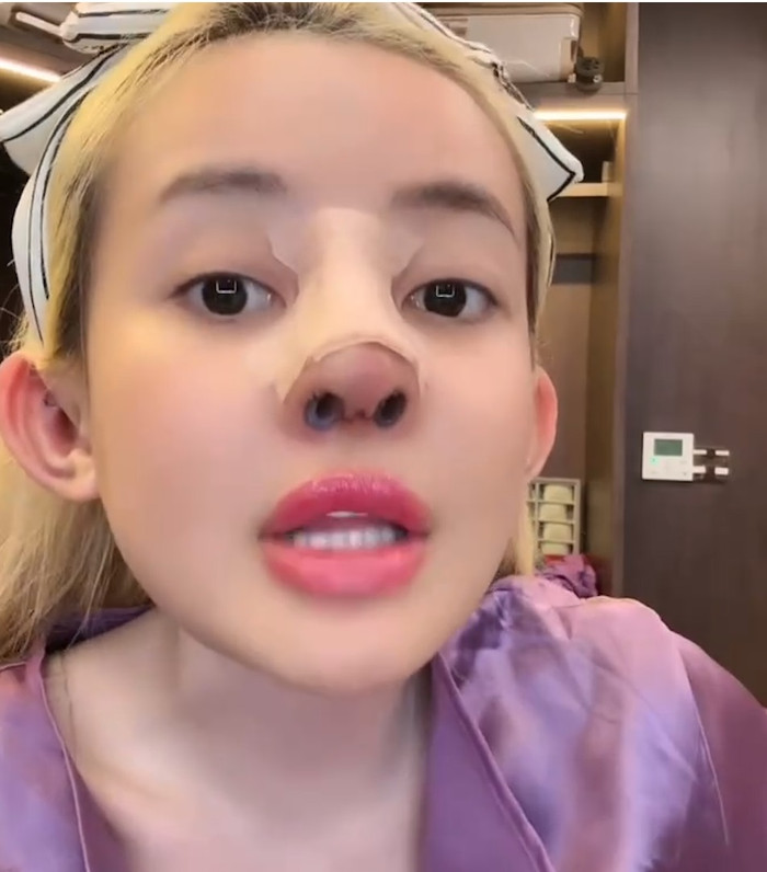 Nữ DJ cho biết hiện rất đau, thậm chí còn bị xỉu sau khi làm lại mũi. (Ảnh chụp màn hình)