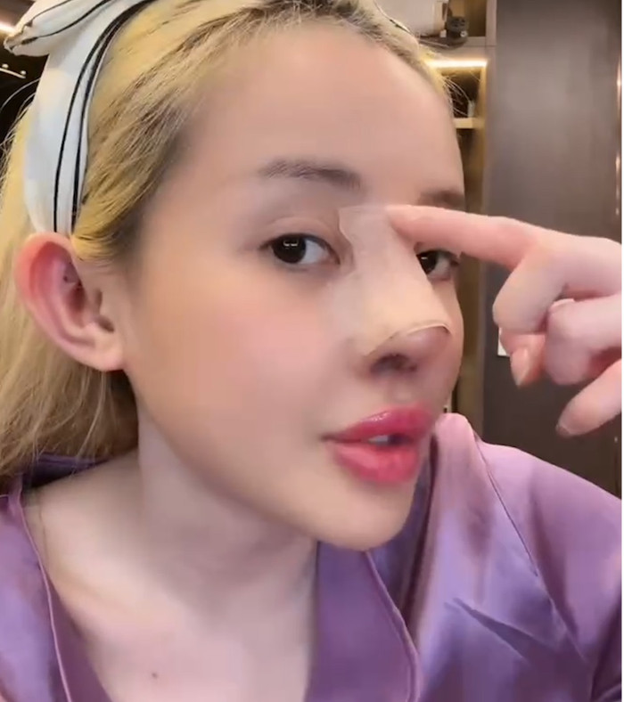 Ngân 98 vừa đi tháo sụn mũi giả sau khi bị nhiễm trùng nặng. (Ảnh chụp màn hình)