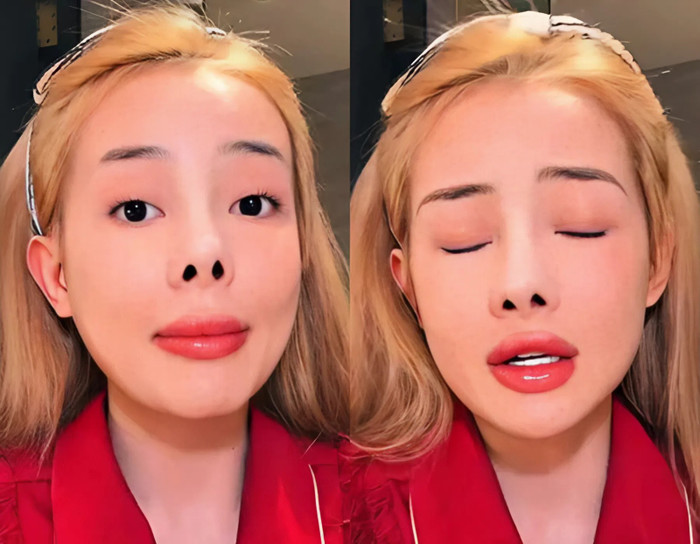 Nữ DJ bị biến chứng, mũi co rút sau nhiều lần can thiệp dao kéo. (Ảnh từ FBNV)