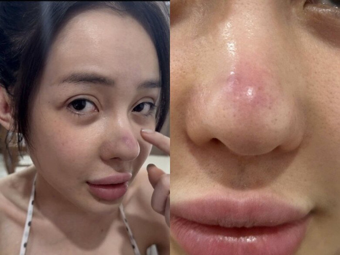 Nữ DJ từng phải tạm ngừng công việc vì viêm mũi, biến chứng từ nhiều lần phẫu thuật thẩm mỹ. (Ảnh từ FBNV)