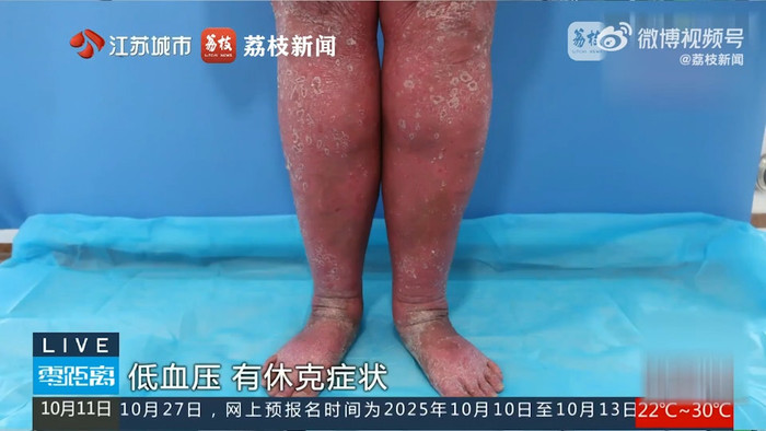 Bôi thuốc trị ngứa mua trên mạng, cơ thể người phụ nữ biến dạng kinh hoàng Ảnh 2