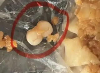 Phát hiện 'răng người' trong xúc xích và bánh bao hấp, mạng xã hội rúng động Ảnh 1