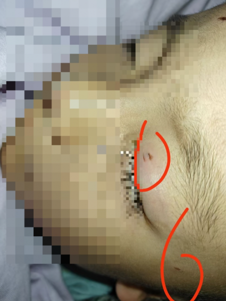 Giáo viên bôi mỡ lợn vào vết thương, cậu bé 4 tuổi bị mù mắt vĩnh viễn Ảnh 1