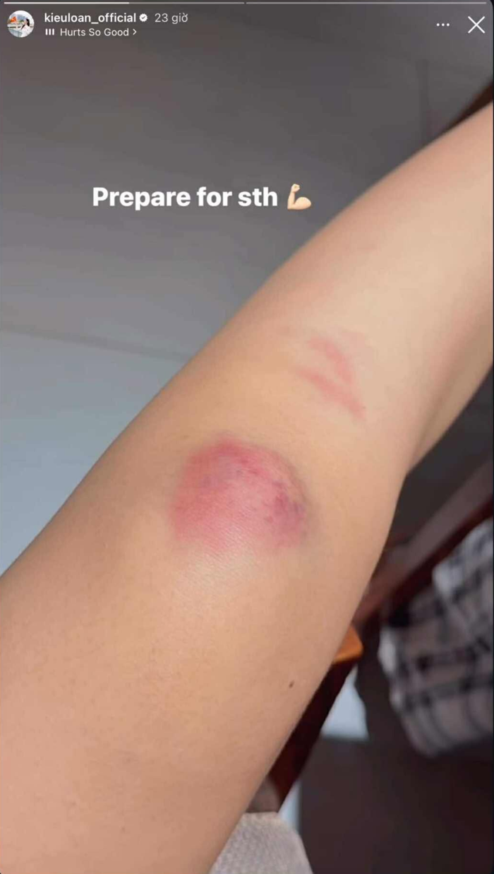 Đầu gối bị bầm đỏ của Á hậu Lona Kiều Loan. (Ảnh chụp màn hình)