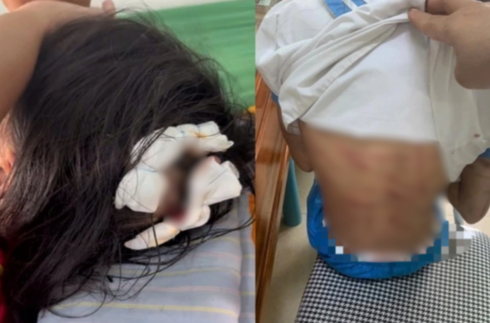 Nữ sinh bị bạo hành với nhiều vết thương ở đầu và cơ thể. (Nguồn: Dân trí)