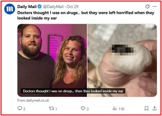 Người đàn ông bị đau một bên tai dữ dội, bác sĩ nội soi thì phát hiện thứ kinh hoàng bên trong Ảnh 2
