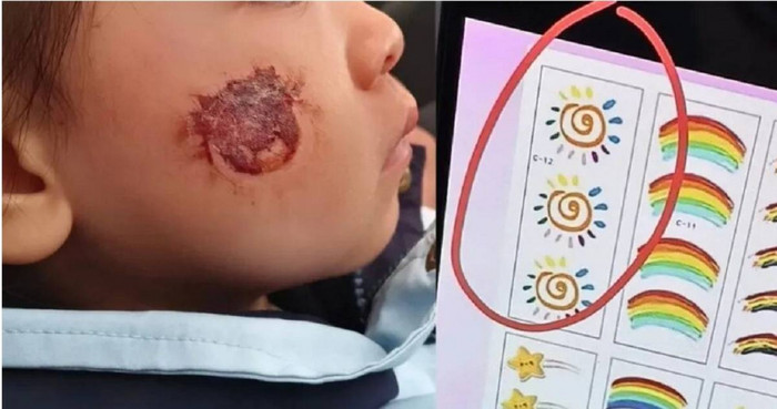 Dán hình lên mặt theo lời cô giáo, bé gái 3 tuổi gặp tình trạng khiến phụ huynh hoảng hốt Ảnh 1