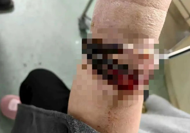 Đeo vòng tay suốt 10 năm không tháo, người phụ nữ 33 tuổi gặp sự cố kinh hoàng Ảnh 1