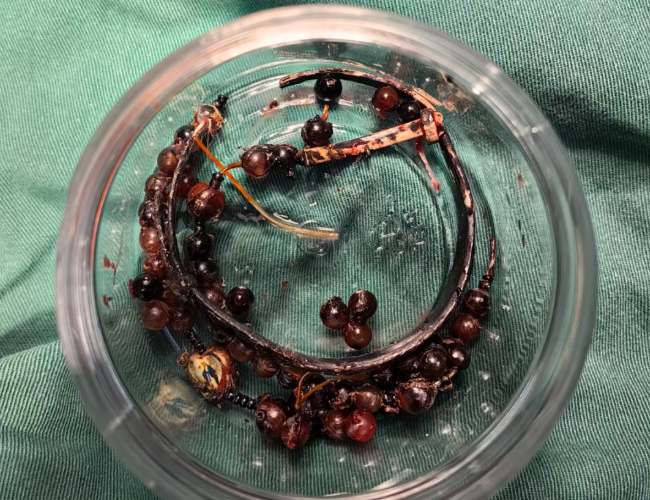 Đeo vòng tay suốt 10 năm không tháo, người phụ nữ 33 tuổi gặp sự cố kinh hoàng Ảnh 3