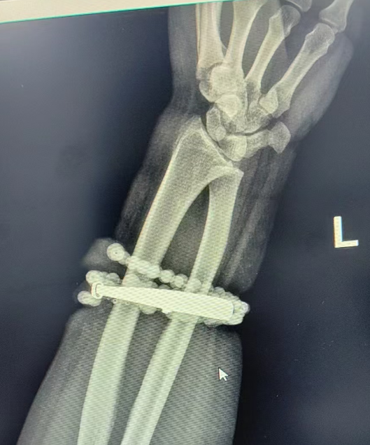 Đeo vòng tay suốt 10 năm không tháo, người phụ nữ 33 tuổi gặp sự cố kinh hoàng Ảnh 2