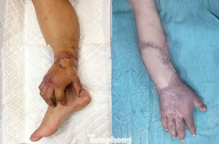 Sau phẫu thuật, hiện sức khỏe bệnh nhân đang trong thời gian hồi phục, được y bác sĩ theo dõi. (Ảnh Tiền phong)