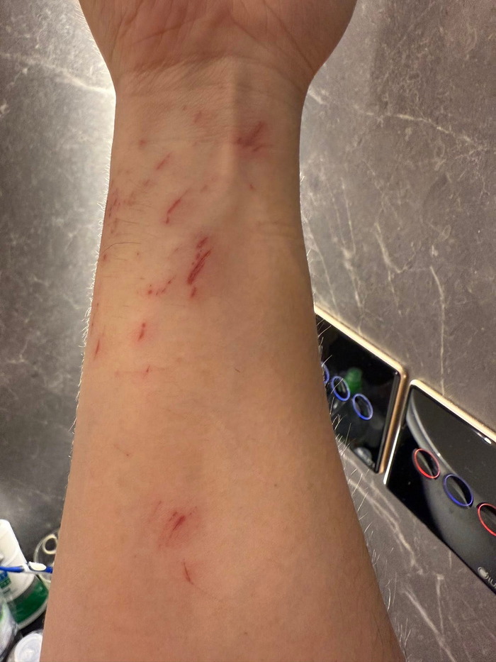 Hình ảnh Trấn Thành thương tích đầy người khi tham gia một chương trình truyền hình khiến nhiều fan xót xa.