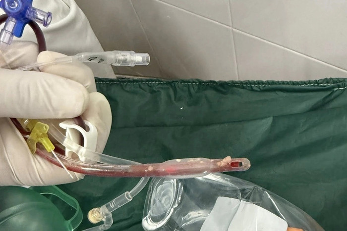 Thức ăn dính vào ống nội khí quản sau khi các bác sĩ hồi sức tim phổi cho bé gái thất bại. Ảnh: Dân Trí