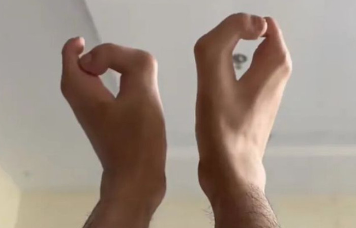 Người đàn ông sinh ra với bàn chân 'móng bò' và tay 'càng cua', lý do ai nghe cũng xót xa Ảnh 1