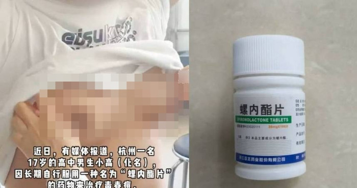 Tự mua thuốc trị mụn, nam sinh 17 tuổi choáng váng khi vòng một phát triển như con gái Ảnh 1