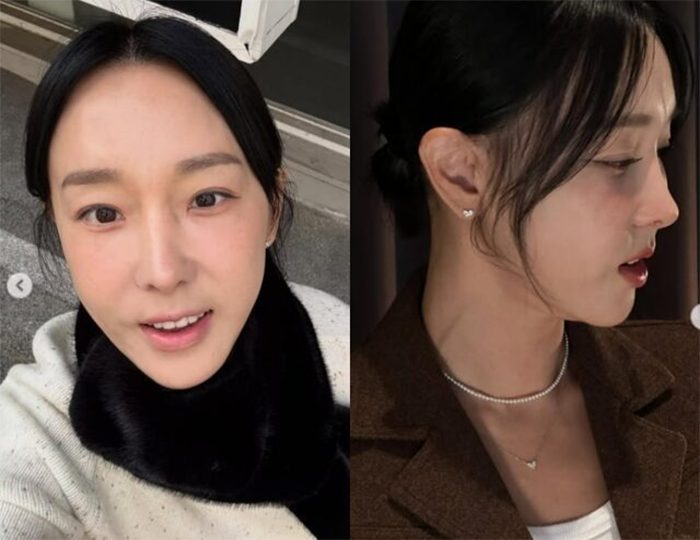 Lee Ji Hye trước và sau khi làm phẫu thuật thu nhỏ, rút ngắn nhân trung.