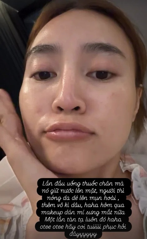Hồi tháng 10 vừa qua, Ninh Dương Lan Ngọc từng tiết lộ tình trạng của làn da bị ảnh hưởng sau khi cô uống thuốc điều trị chấn thương. (Ảnh chụp màn hình)