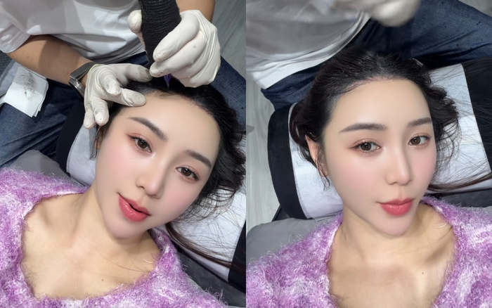 Quỳnh Kool thoải mái chia sẻ việc làm thủ thuật thẩm mỹ ở tuổi 30. Ảnh chụp màn hình