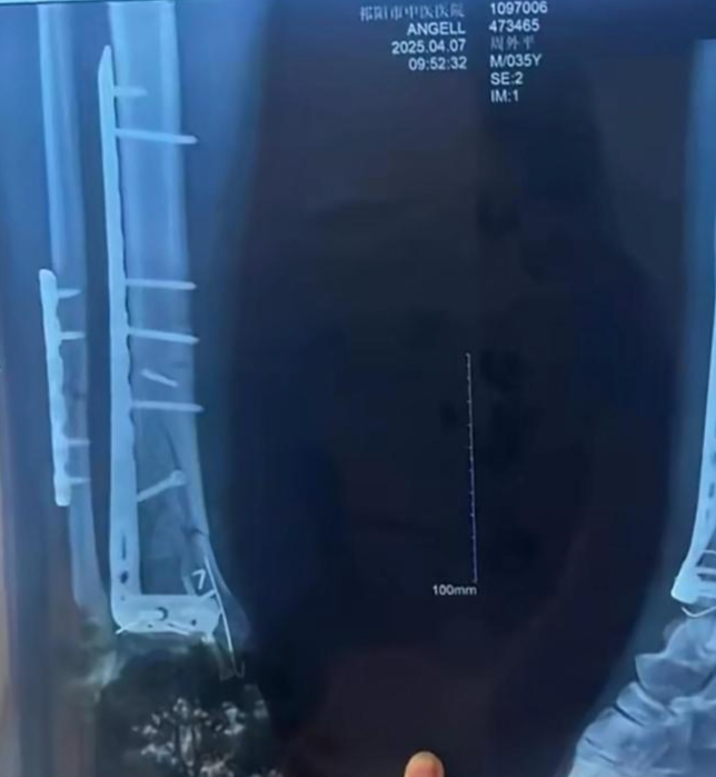 Hai bệnh nhân có triệu chứng lạ sau phẫu thuật, bệnh viện che giấu sự thật suốt nửa năm Ảnh 2