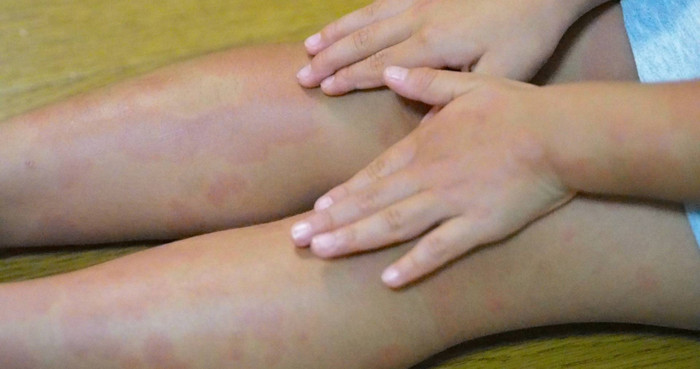 Bé gái 4 tuổi mắc bệnh giang mai, nguyên nhân đến từ thói quen của bà nội Ảnh 1