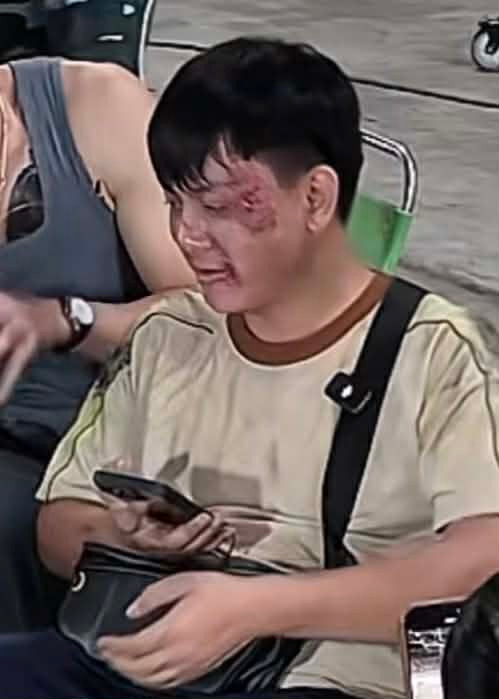 Hoài Lâm thương tích đầy mặt gây xôn xao Ảnh 2