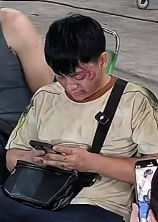 Hoài Lâm thương tích đầy mặt gây xôn xao Ảnh 1