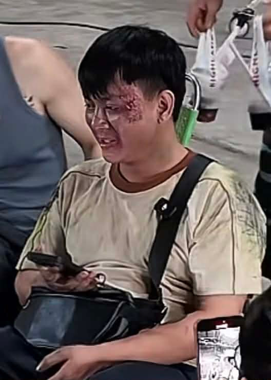 Hoài Lâm thương tích đầy mặt gây xôn xao Ảnh 3