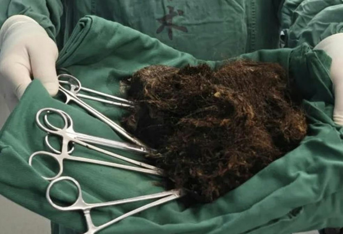 Ăn tóc suốt 20 năm, cô gái khiến dư luận 'dậy sóng' khi bác sĩ lấy ra 'tảng đá' nặng 1kg trong dạ dày Ảnh 1