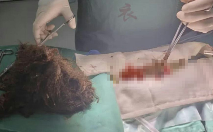 Ăn tóc suốt 20 năm, cô gái khiến dư luận 'dậy sóng' khi bác sĩ lấy ra 'tảng đá' nặng 1kg trong dạ dày Ảnh 2