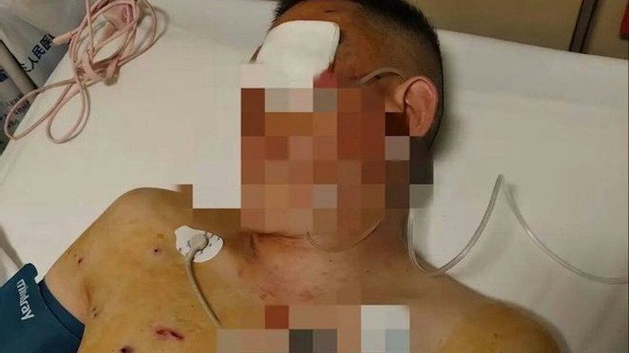 Rút hơn 6 tỷ đồng ngay trước ngân hàng, người đàn ông gặp nguy hiểm dẫn đến mất một mắt Ảnh 1