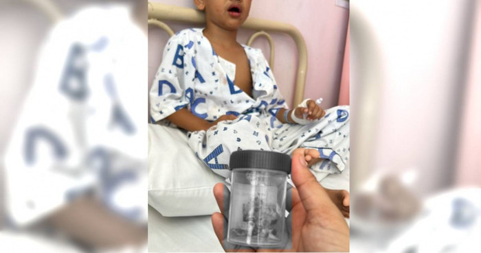 Bé trai phải nhổ một lúc 12 chiếc răng, nguyên nhân xuất phát từ thói quen khó bỏ Ảnh 1