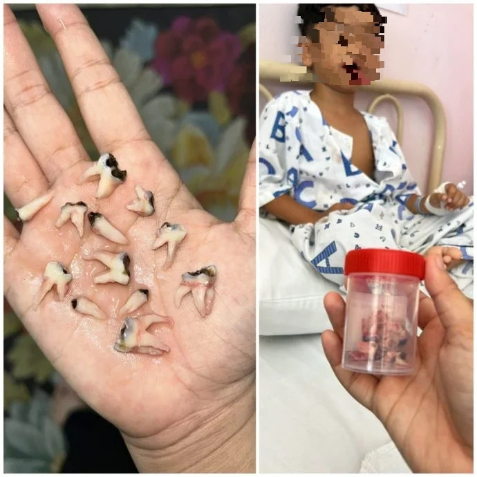 Bé trai phải nhổ một lúc 12 chiếc răng, nguyên nhân xuất phát từ thói quen khó bỏ Ảnh 2