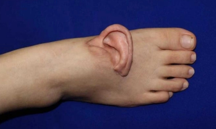 Cô gái có lỗ tai 'mọc' trên mu bàn chân, sự việc đằng sau khiến nhiều người nể phục Ảnh 1