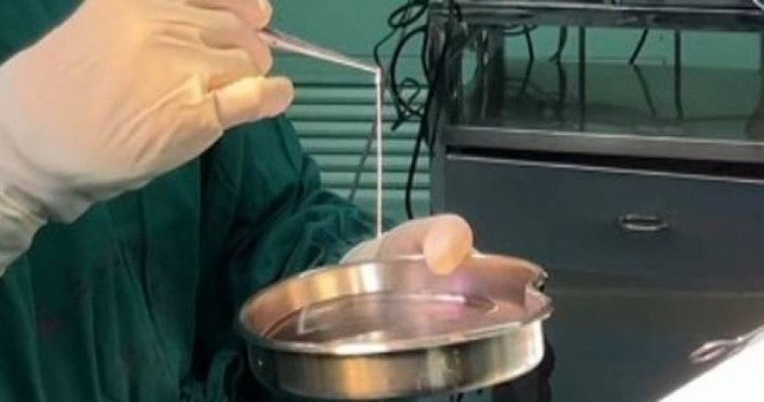 Người đàn ông bị động kinh hơn 20 năm, bác sĩ bàng hoàng khi phát hiện thứ bên trong não Ảnh 1