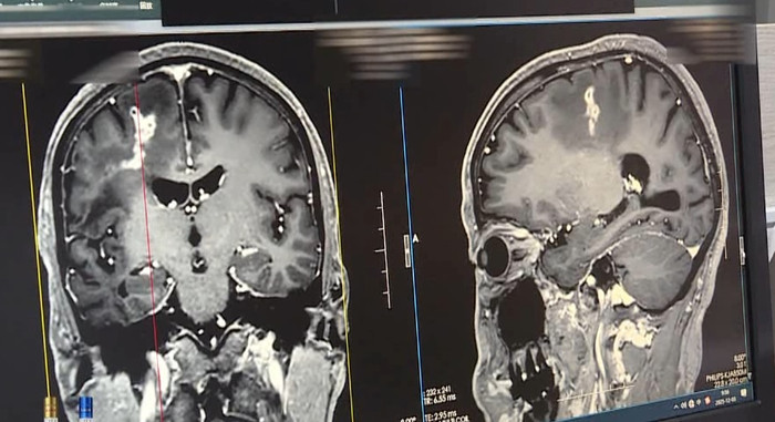 Người đàn ông bị động kinh hơn 20 năm, bác sĩ bàng hoàng khi phát hiện thứ bên trong não Ảnh 3