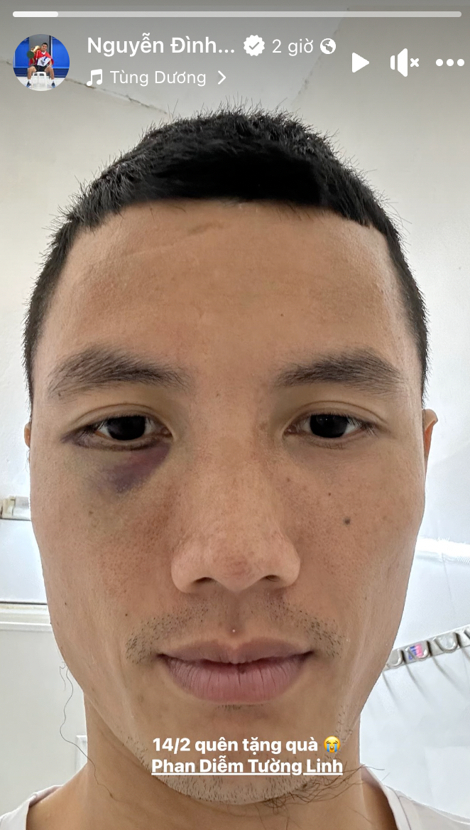 Thủ môn Đình Triệu đăng tải ảnh bầm tím một bên mắt gây chú ý. (Ảnh chụp màn hình)