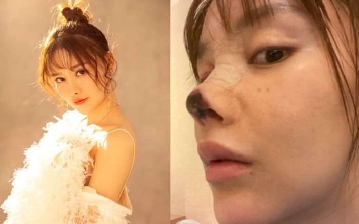 Các ca phẫu thuật thẩm mỹ lỗi khiến các cô gái 'điêu đứng' Ảnh 2