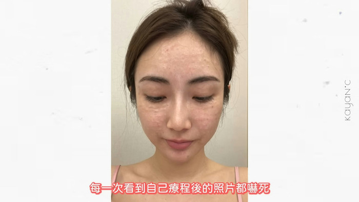 Dù yêu thích cái đẹp, Thái Gia Hân chỉ sử dụng nhiều biện pháp thẩm mỹ không xâm lấn như tiêm filler, botox và HIFU, Thermage, Ultherapy.