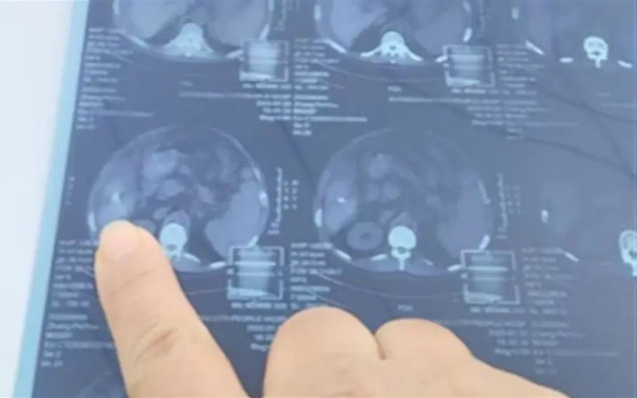 Người đàn ông 59 tuổi hoang mang khi phát hiện một thứ sót lại trong cơ thể sau ca phẫu thuật Ảnh 2